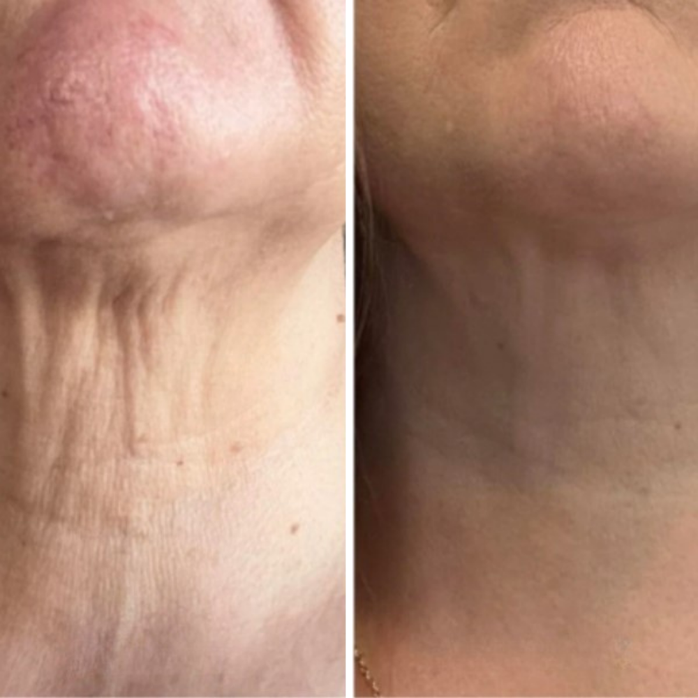 Lachs-DNA Bio-Kollagen Lifting-Creme für Gesicht, Hals & Doppelkinn